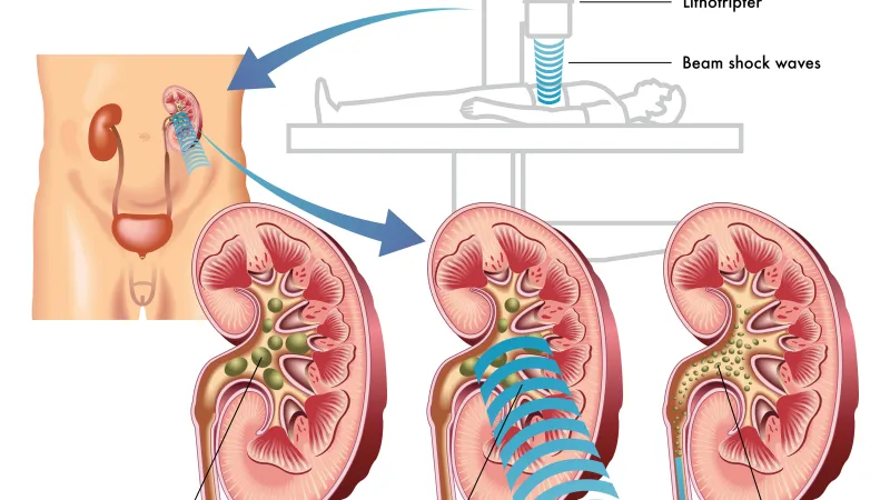 Extracorporeal shock wave lithotripsy ESWL